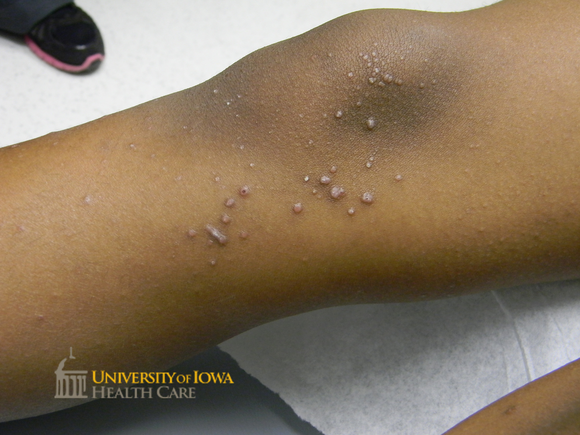 Pink to violaceous polygonal papules with overlying white scale on the lower legs. (click images for higher resolution).